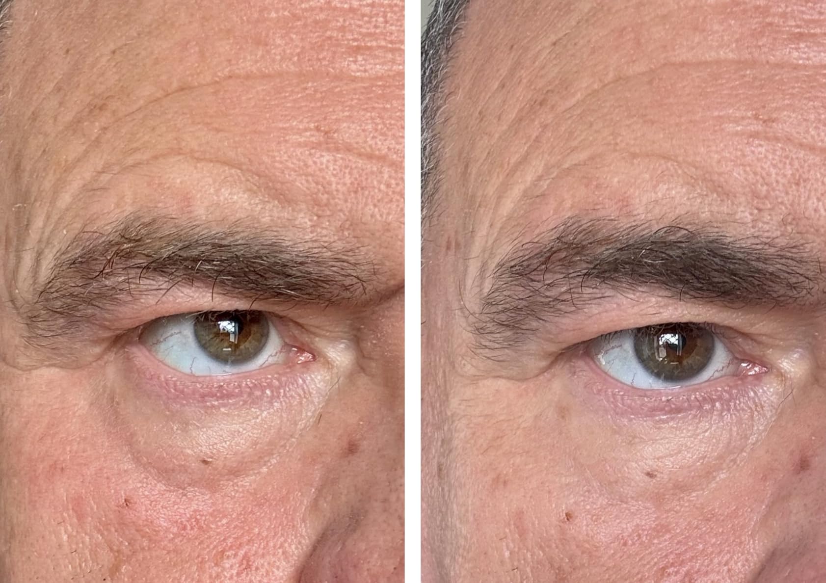 Customer-submitted eye-area before and after image