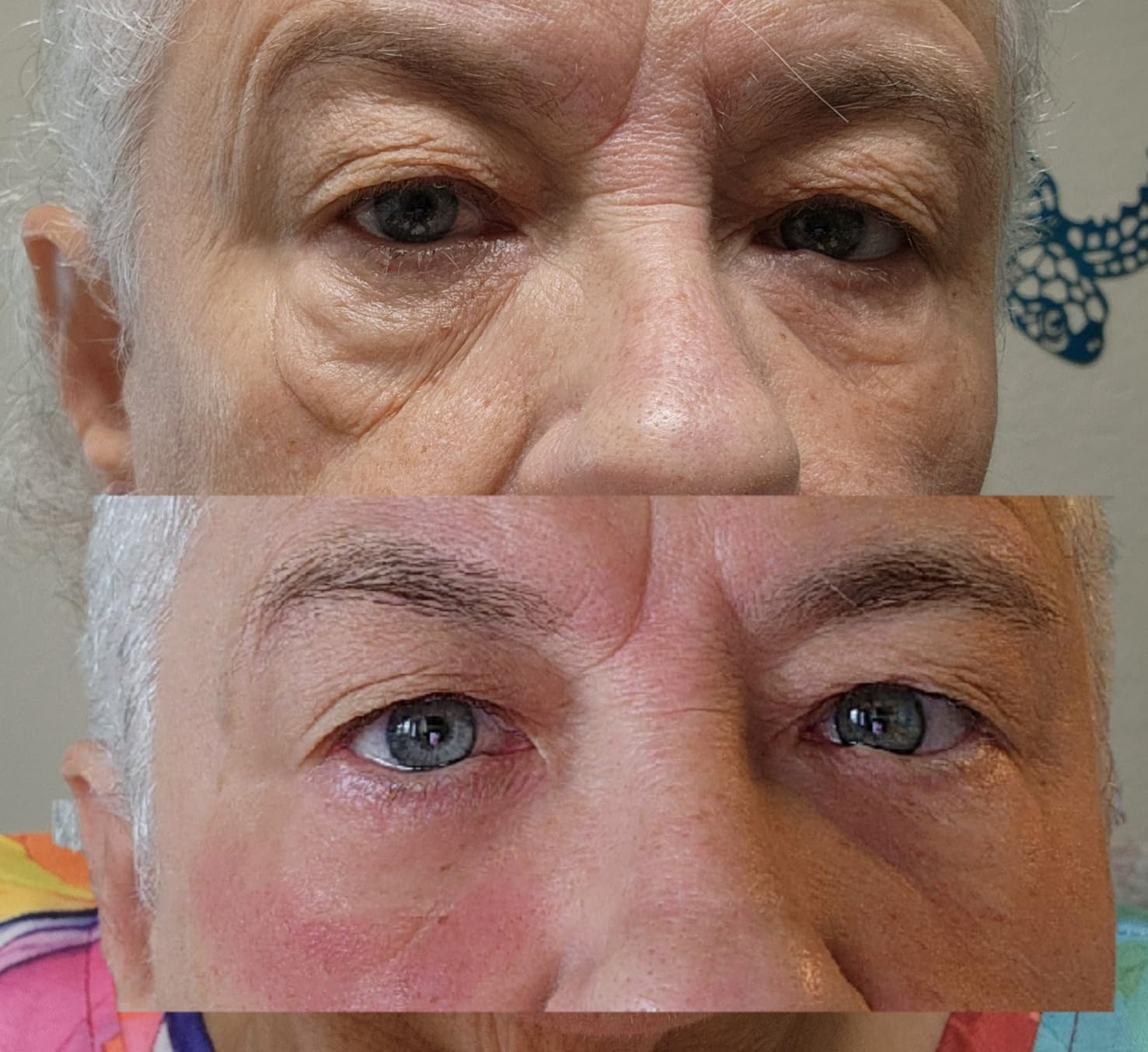 Customer-submitted eye-area before and after image