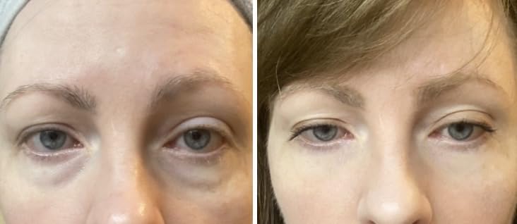 Customer-submitted eye-area before and after image