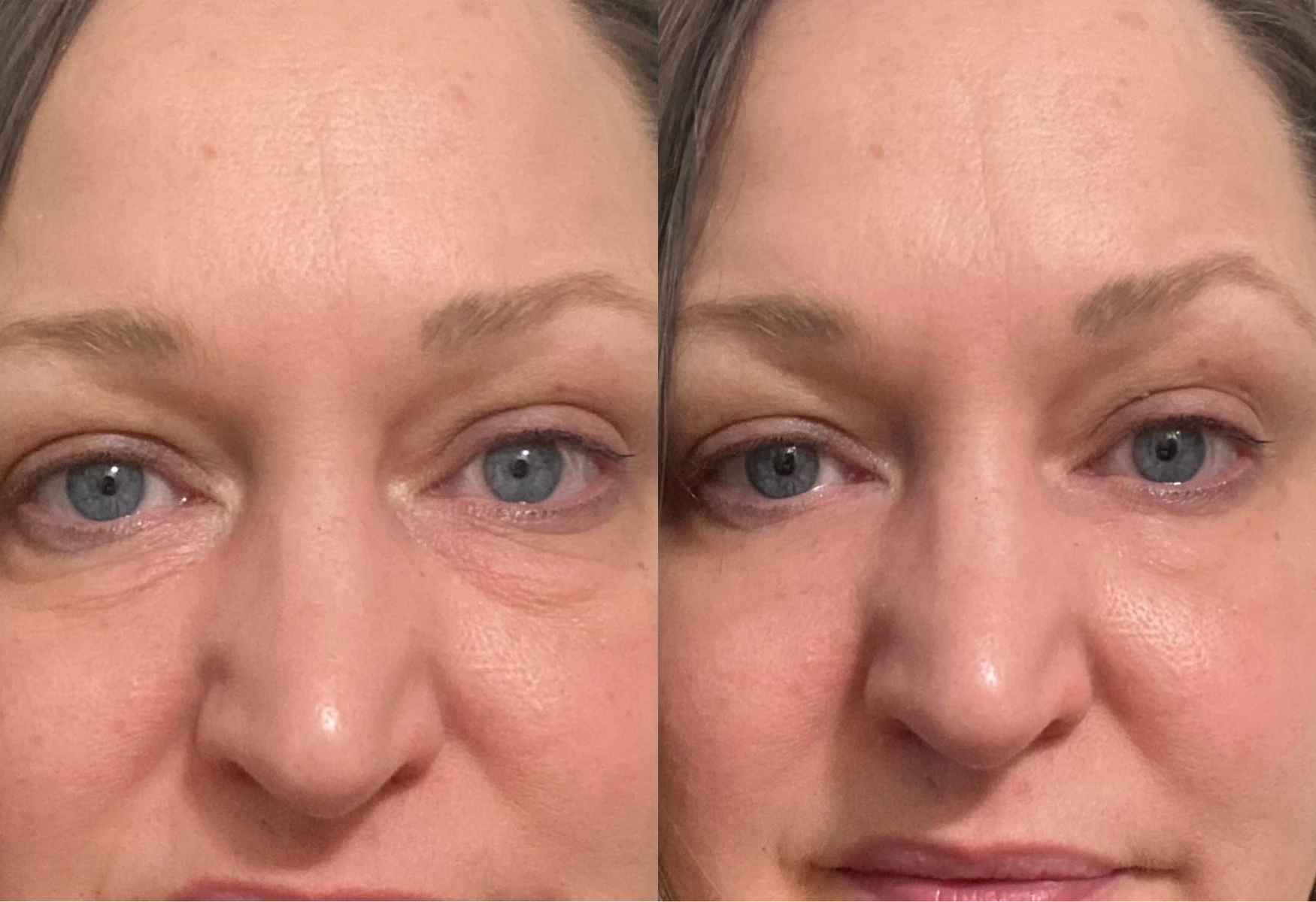 Customer-submitted eye-area before and after image